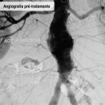Angiografia pré tratamento