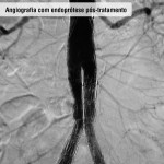 Angiografia com endoprótese pós tratamento