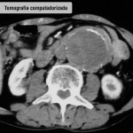 Tomografia computadorizada