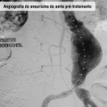 Angiografia do aneurisma de aorta pré tratamento