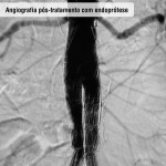 Angiografia pós tratamento com endoprótese