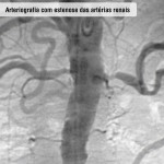 Arteriografia com estenose das artérias renais