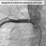 Angiografia de controle sem estenose da artéria renal