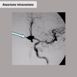 Aneurisma intracraniano