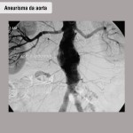 Aneurisma aorta