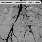 Estenose da artéria ilíaca comum direita e oclusão da esquerda