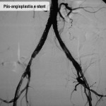 Pós angioplastia e stent