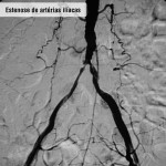 Estenose de artérias ilíacas