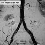 Pós angioplastia e stent