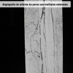 Angiogrfia de artérias da perna com múltiplas estenoses