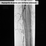 Angiografia da perna com múltiplas estenoses
