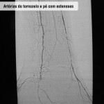 Artérias do tornozelo e pé com estenoses