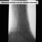 Artérias do tornozelo e pé com múltiplas estenoses