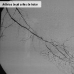 Artérias do pé antes de tratar