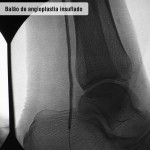 Balão de angioplastia insuflado