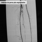 Artérias da perna pós angioplastia