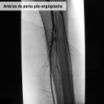 Artérias da perna pós angioplastia