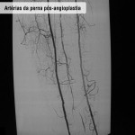 Arterias da perna pós angioplastia
