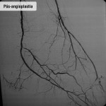 Pós angioplastia