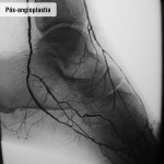 Pós angioplastia