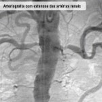 Arteriografia com estenose das artérias renais