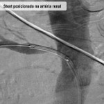 Stent posicionado na artéria renal