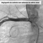 Angiografia de controle sem estenose da artéria renal