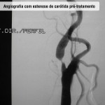 Angiografia com estenose de carótida pré tratamento
