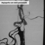 Angiografia com stent posicionado