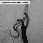Angiografia de controle com estenose