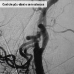Controle pos stent e sem estenose