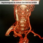 Angiotomografia de controle com stent de carótida