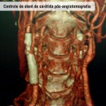 Controle de stent de carótida pós angiotomografia