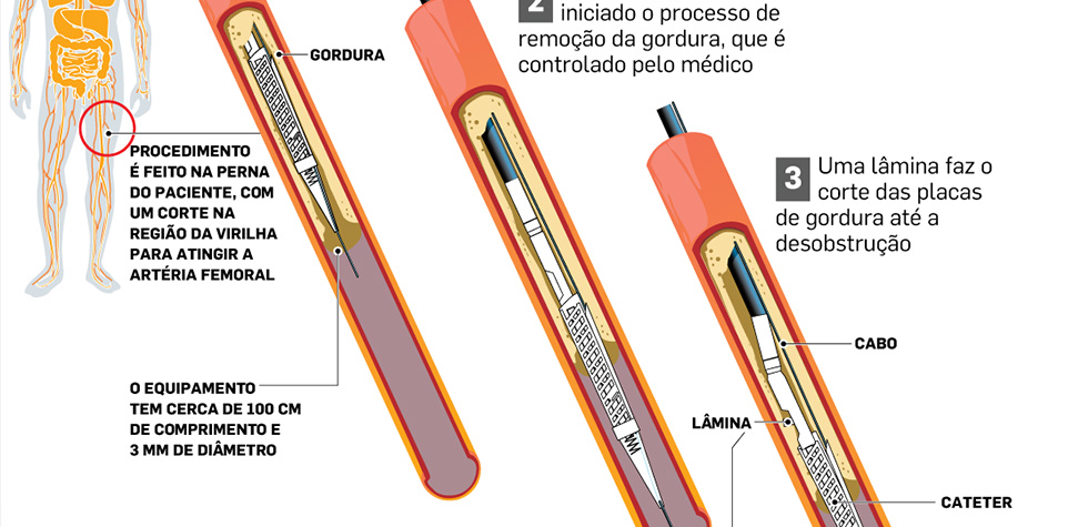 lipoparaarteria